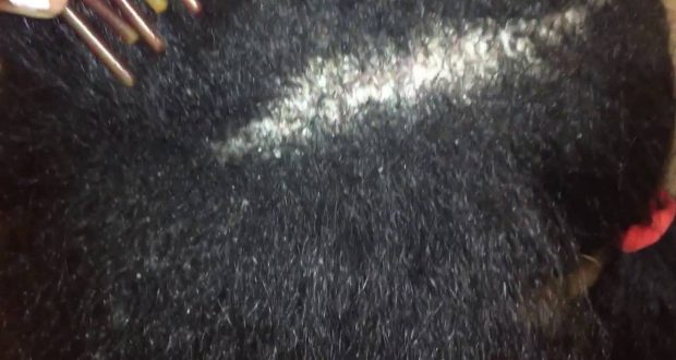 dandruff